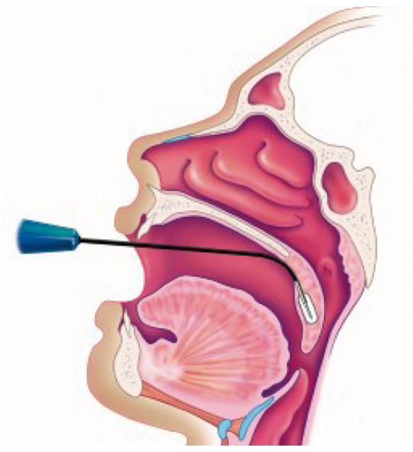 Salvinelli_radiofrequenze_2chirurgia