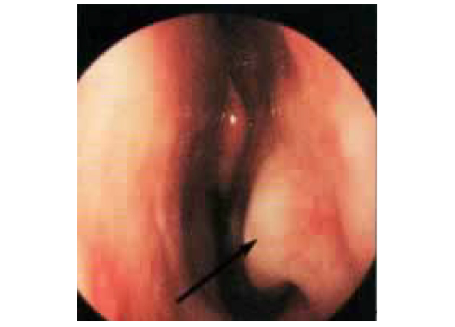 Turbinato_normale_Salvinelli